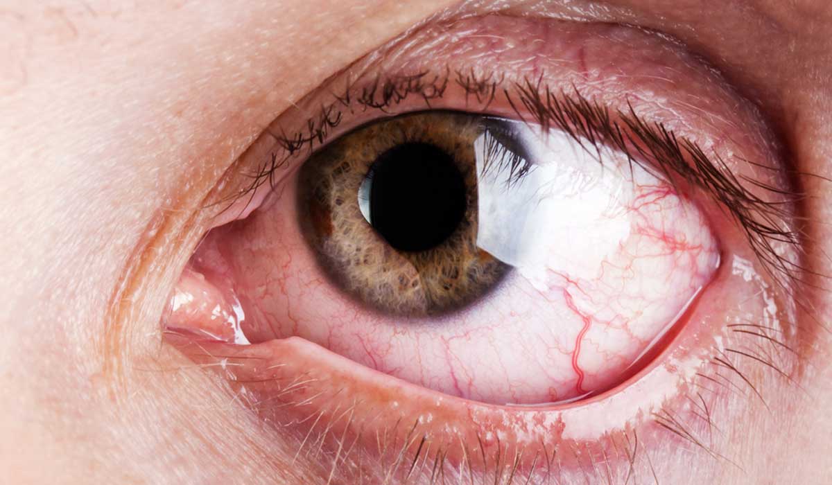 qué es el síndrome del ojo seco