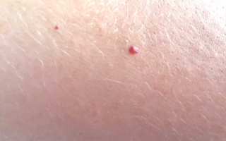 qué significan los puntos rojos en la piel