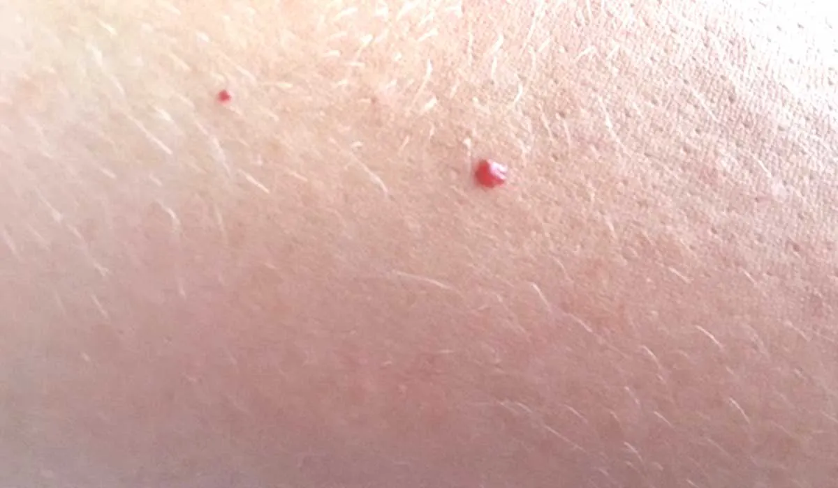 qué significan los puntos rojos en la piel