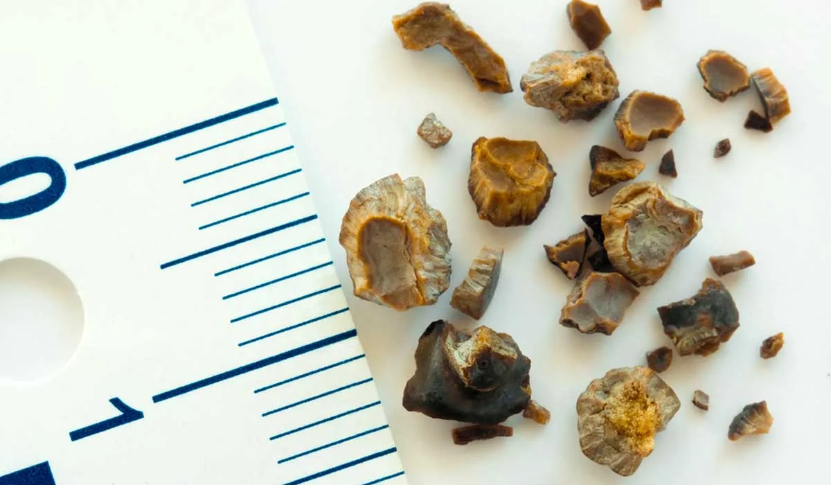 por qué te duele la vesícula