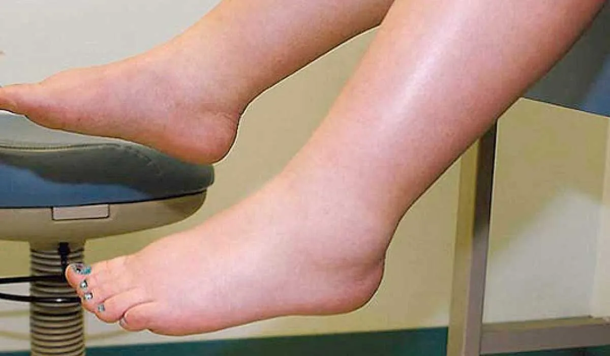 qué es el linfedema