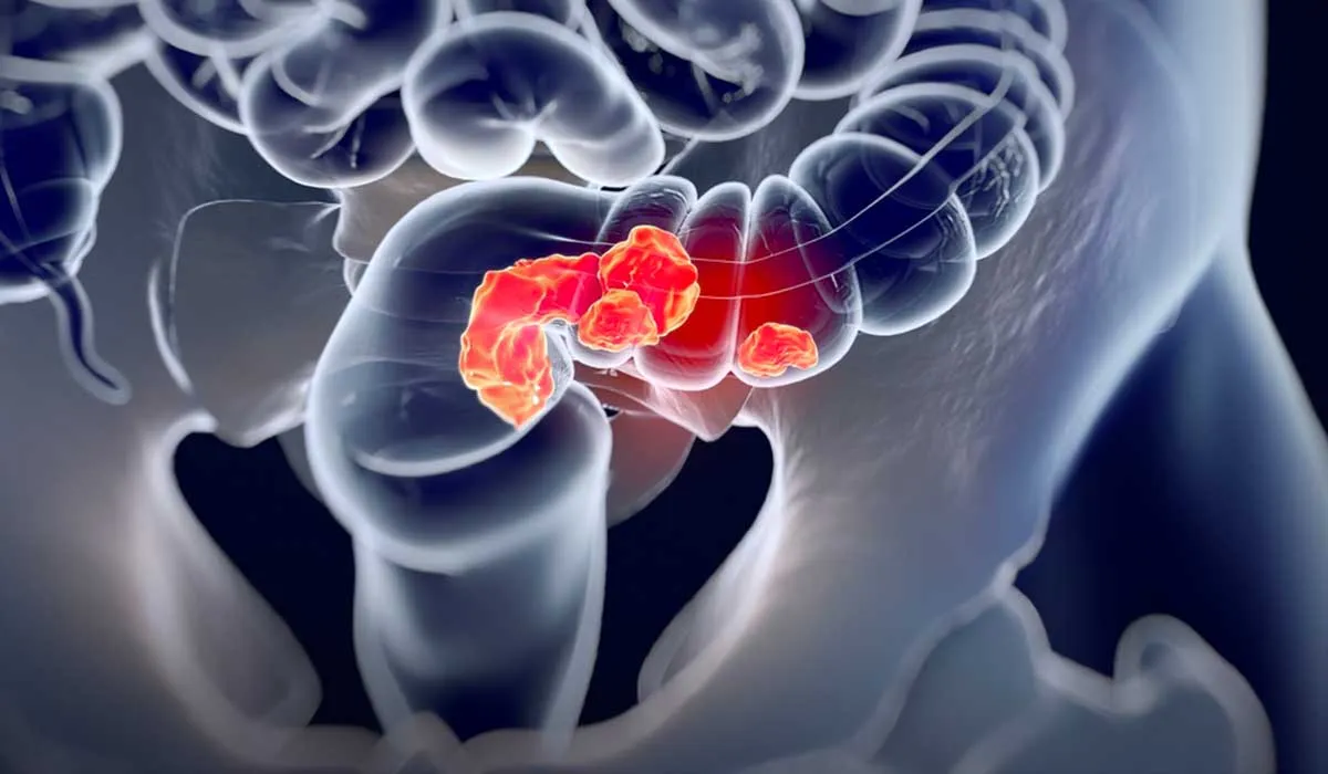 cómo detectar el cáncer colorrectal