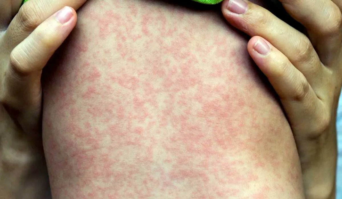 síntomas del sarampión