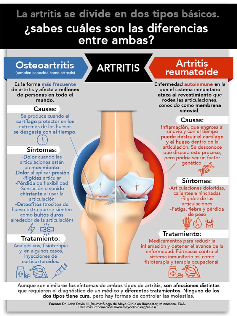Diferencias entre osteoartritis y artritis reumatoide