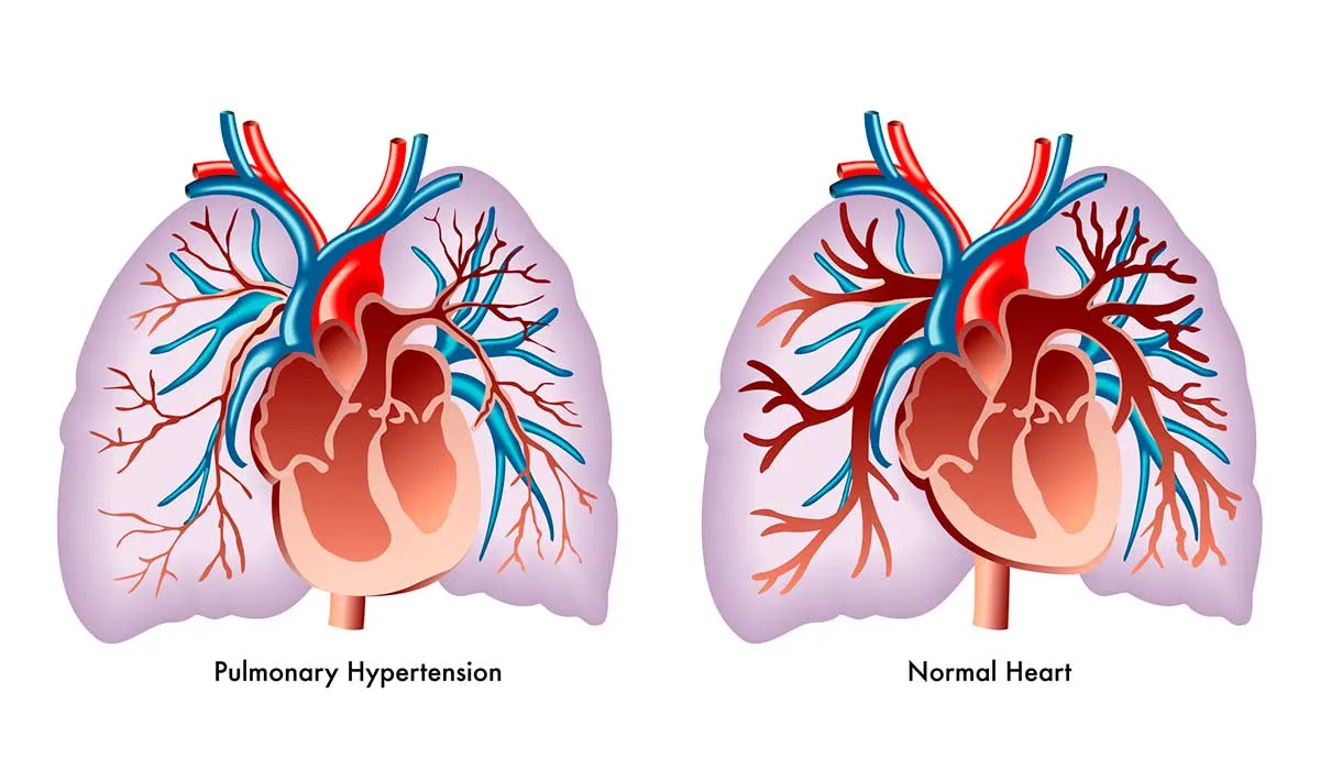 mucho cuidado con la hipertensión arterial pulmonar