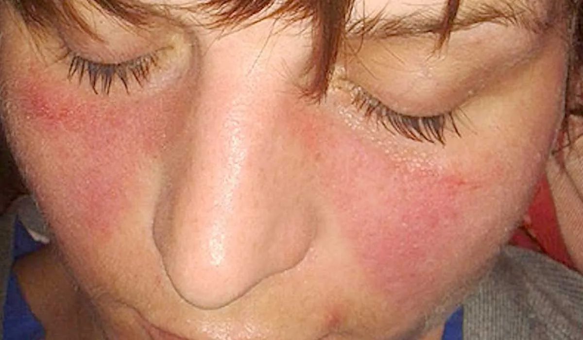 qué puede causar el lupus