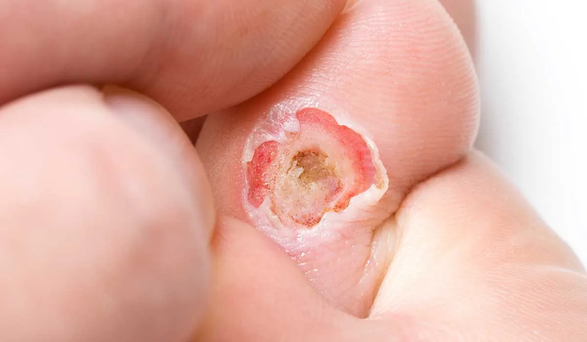 crean parche dérmico para el pie diabético