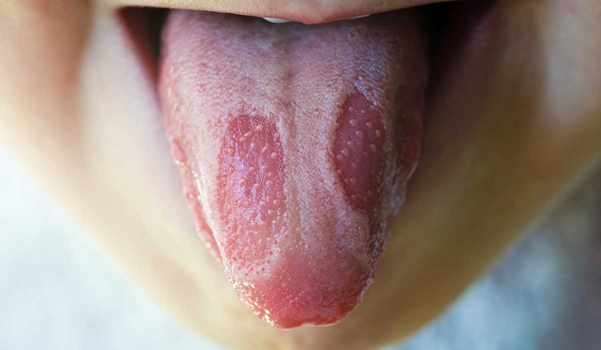 qué enfermedades puedes tener en la lengua