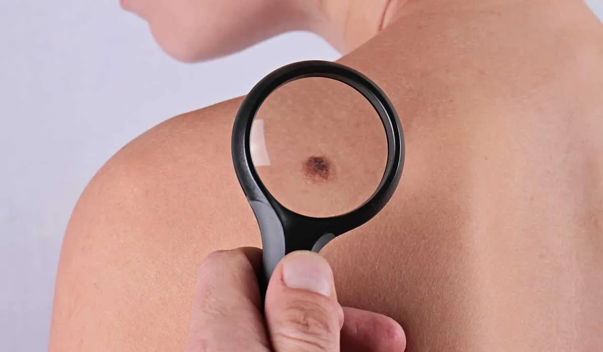 marcas en el cuerpo que podrían ser peligrosas