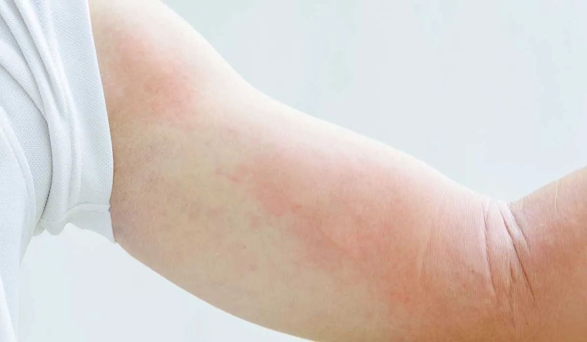 el estrés puede activar la enfermedad llamada culebrilla