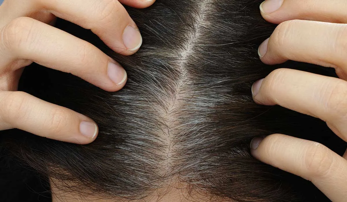 remedios contra las canas prematuras