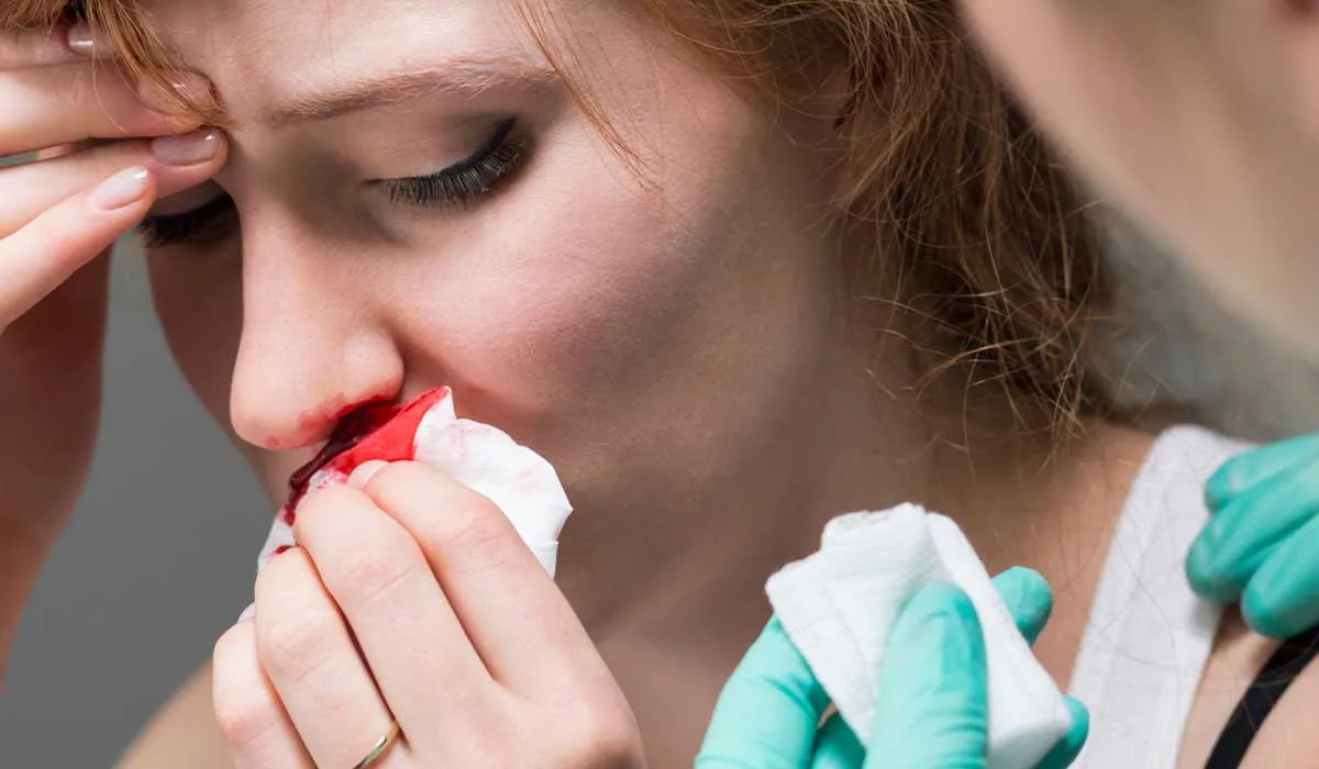 así puedes detener una hemorragia nasal