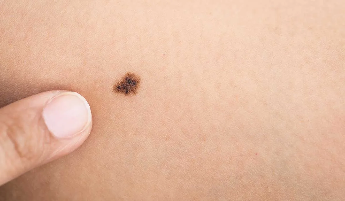 ¿Riesgo de padecer melanoma?