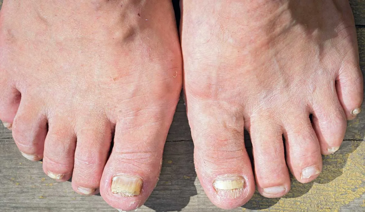 como eliminar los hongos de los pies