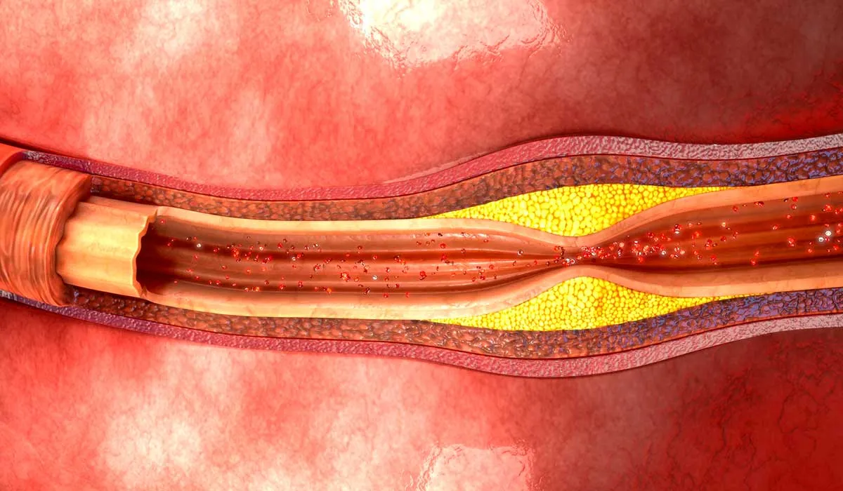 opciones para mejorar el colesterol bueno y disminuir el malo