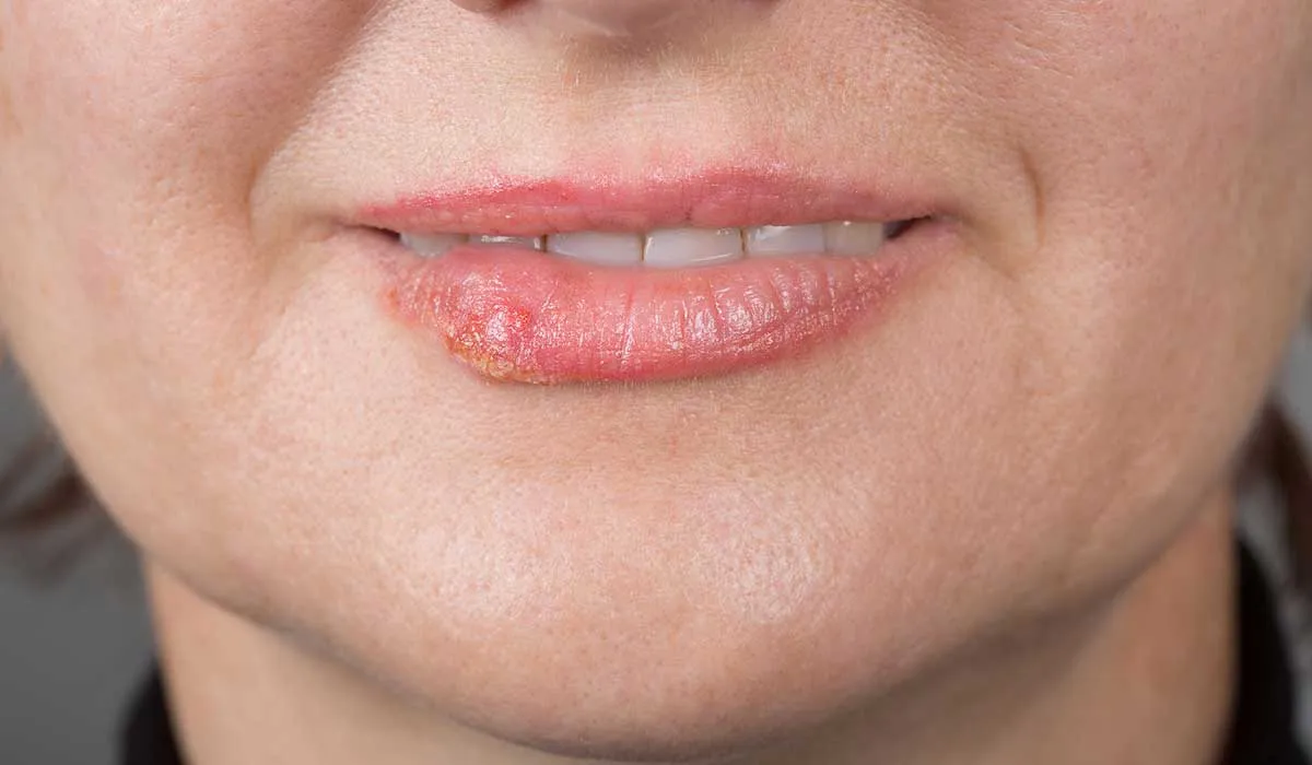 mejora tu herpes labial