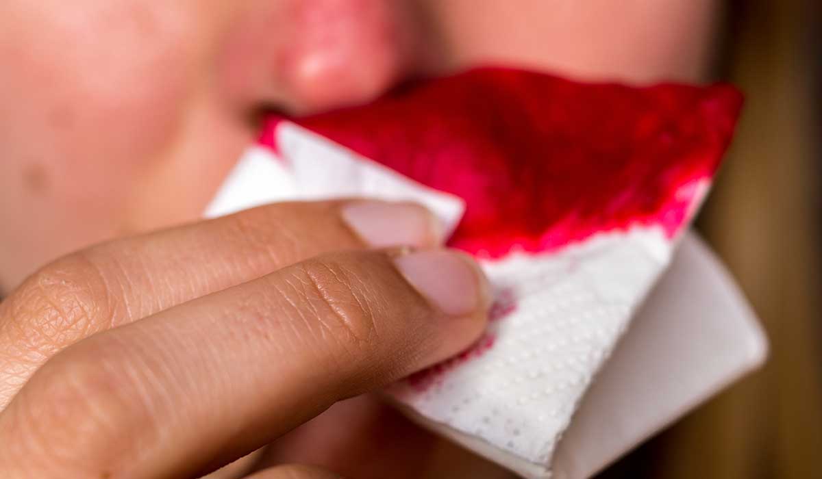 qué causa y cómo tratar las hemorragias nasales