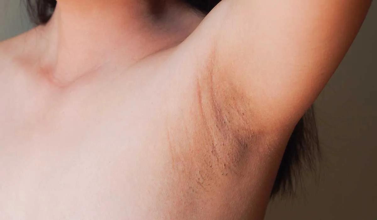 por qué aparecen las manchas en las axilas y cómo evitarlas