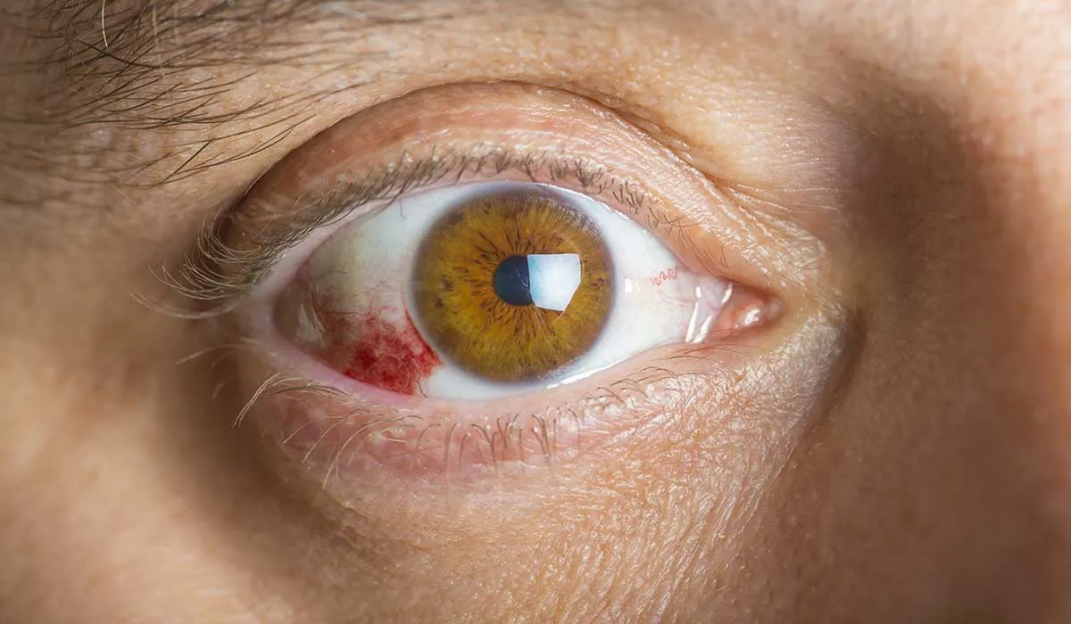 la conjuntivitis puede ser un síntoma de corona virus