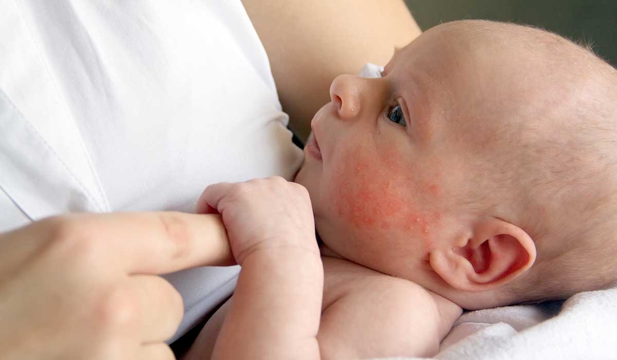cuida a tu bebé de la dermatitis