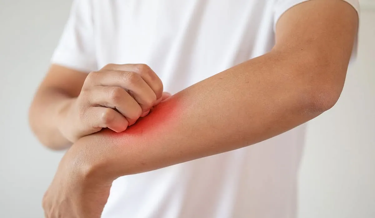 tips para eliminar el sarpullido