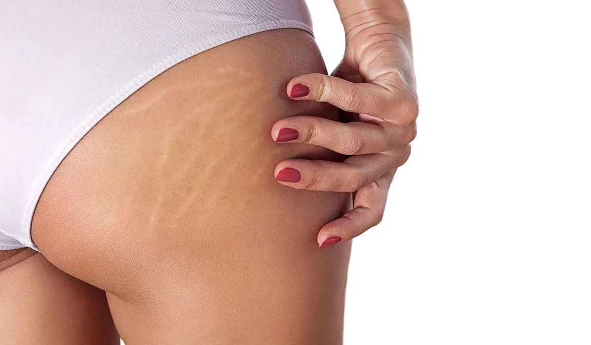 consejos de dermatólogos contra las estrías