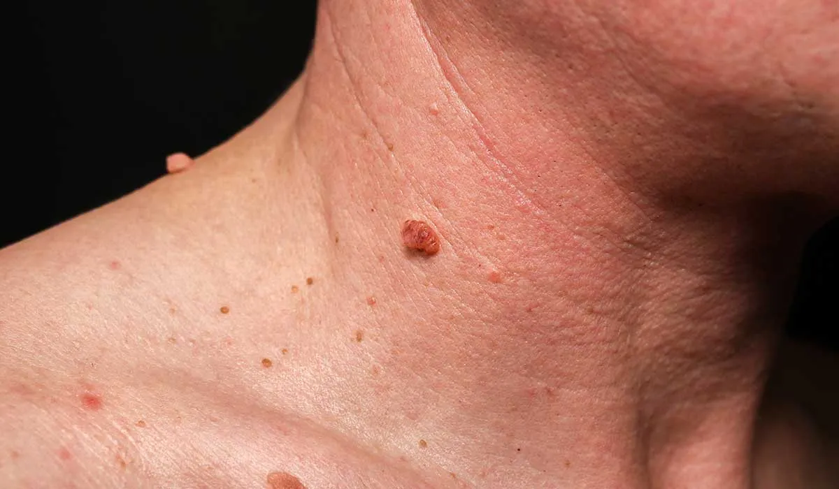 elimina las verrugas con estos tips de dermatólogos