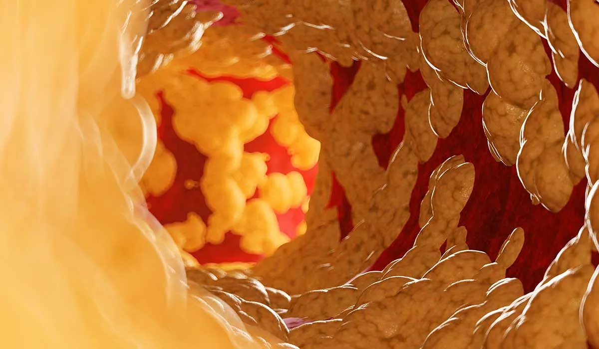 qué pasa si tienes las arterias obstruidas