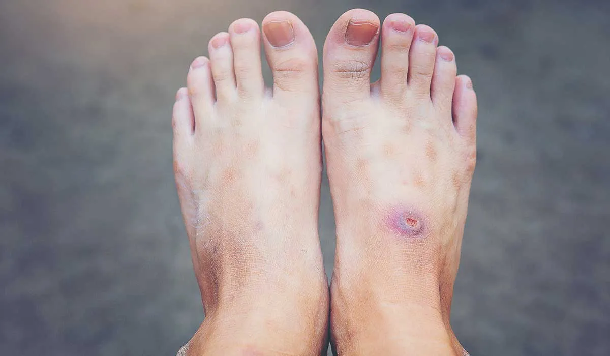 cuida tu pie si tienes diabetes