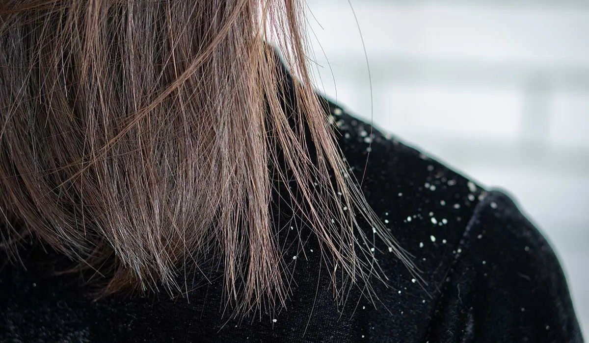 no te confundas con la caspa