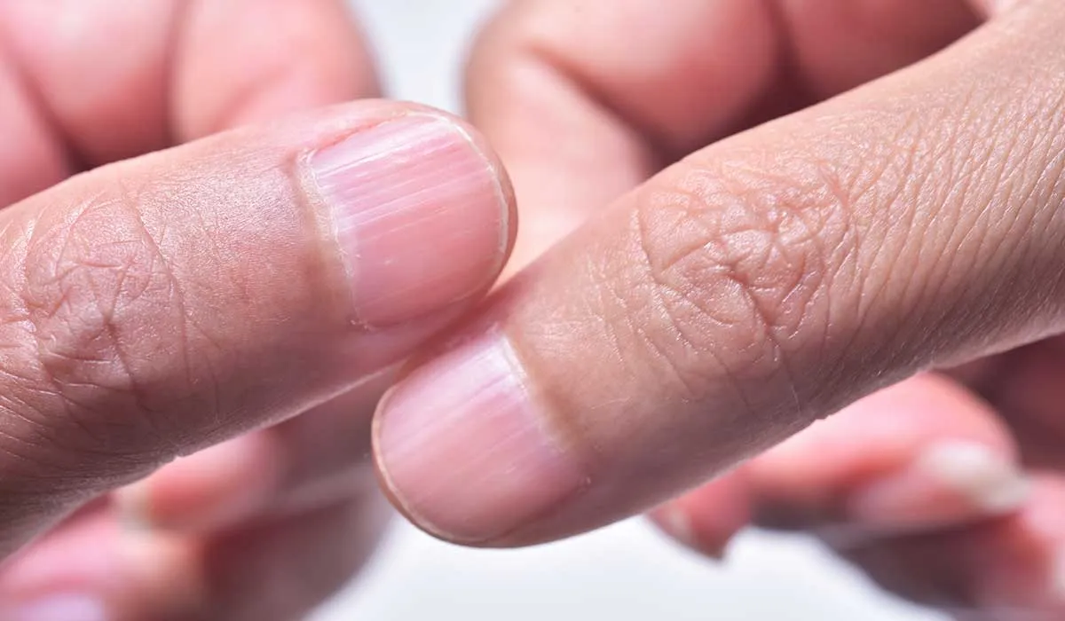 esto significan las crestas en las uñas