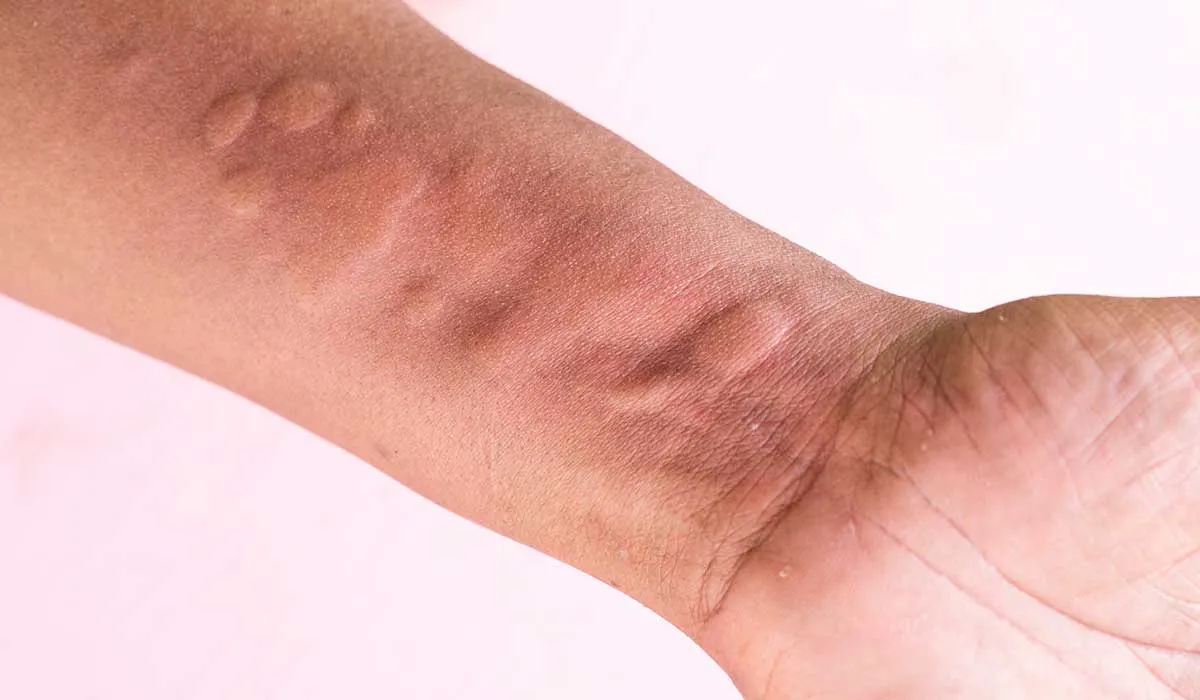 urticaria crónica espontánea