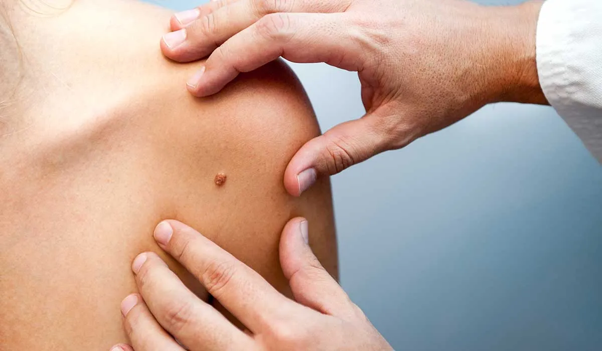 nuevas alternativas para el tratamiento de melanoma