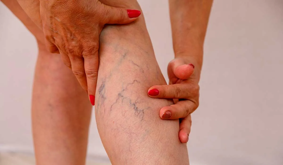 trombosis una enfermedad que puede ser fatal