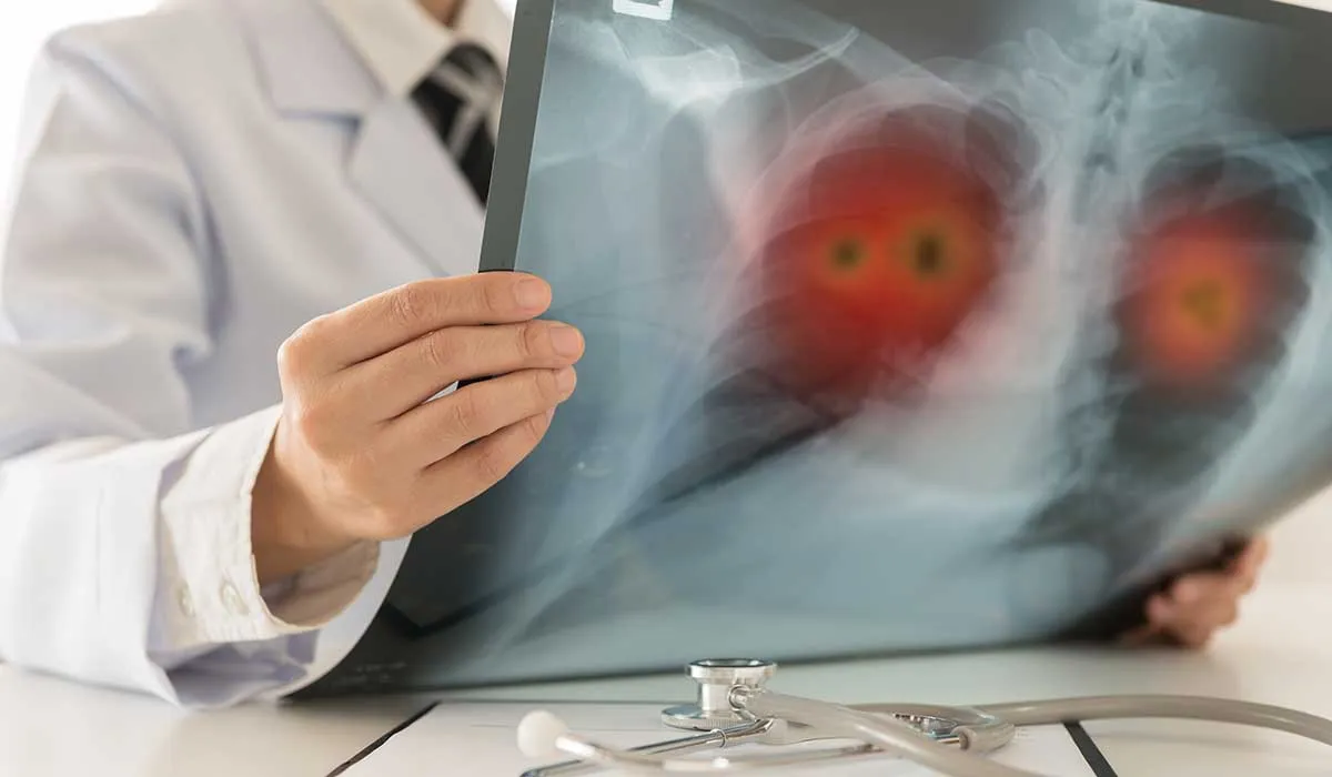 una forma de mejorar el diagnostico para cáncer de pulmón