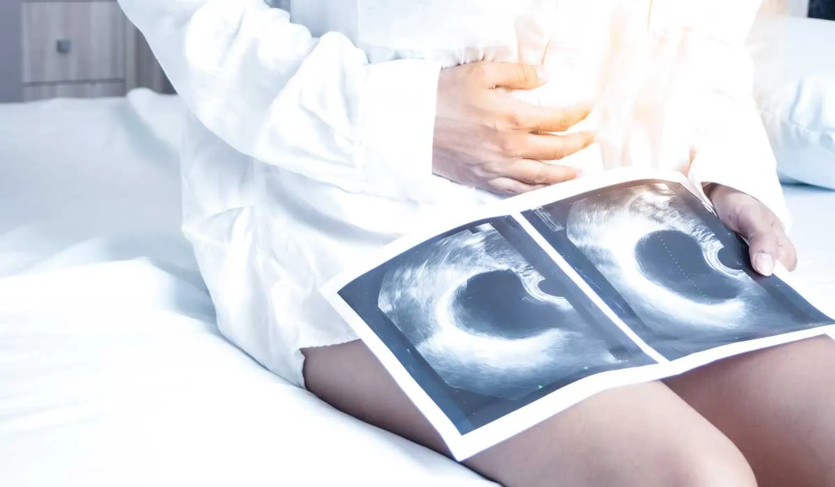 signos silenciosos del cancer de ovario