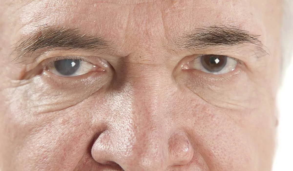 evita la ceguera a causa del glaucoma