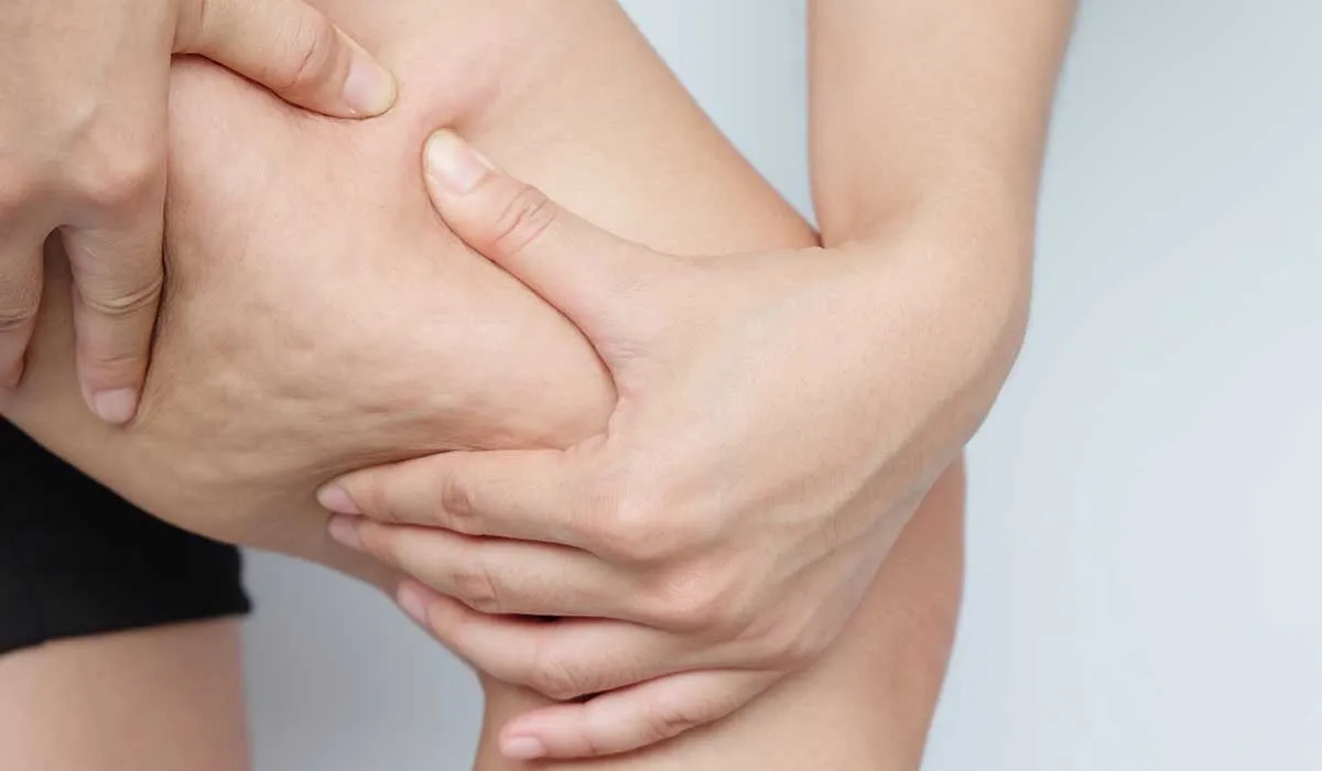 la celulitis puede ser peligrosa para la salud