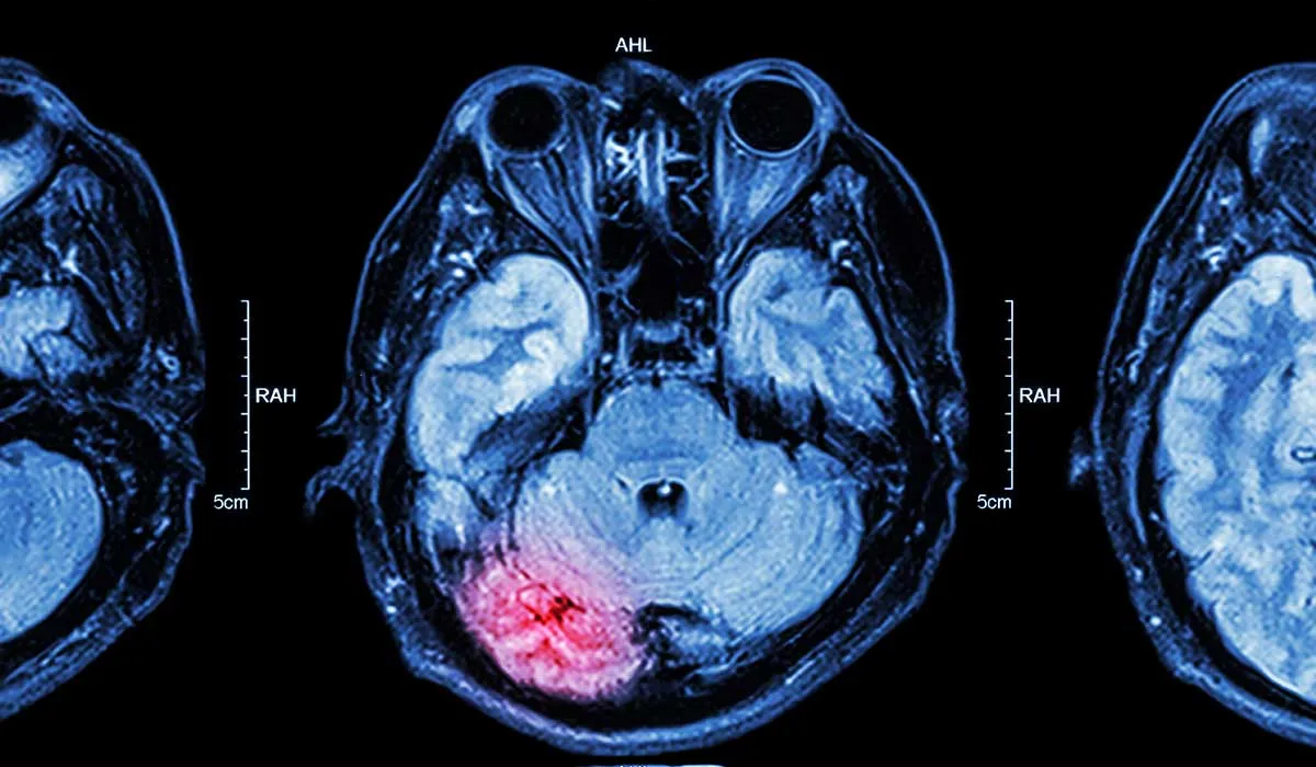 consecuencias de un derrame cerebral silencioso