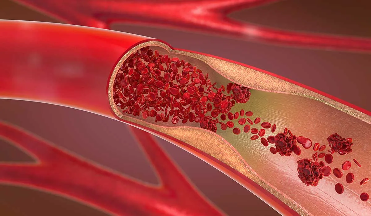 sintomas de arterias obstruidas