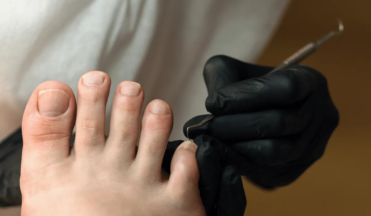 causas de las uñas amarillas en los pies