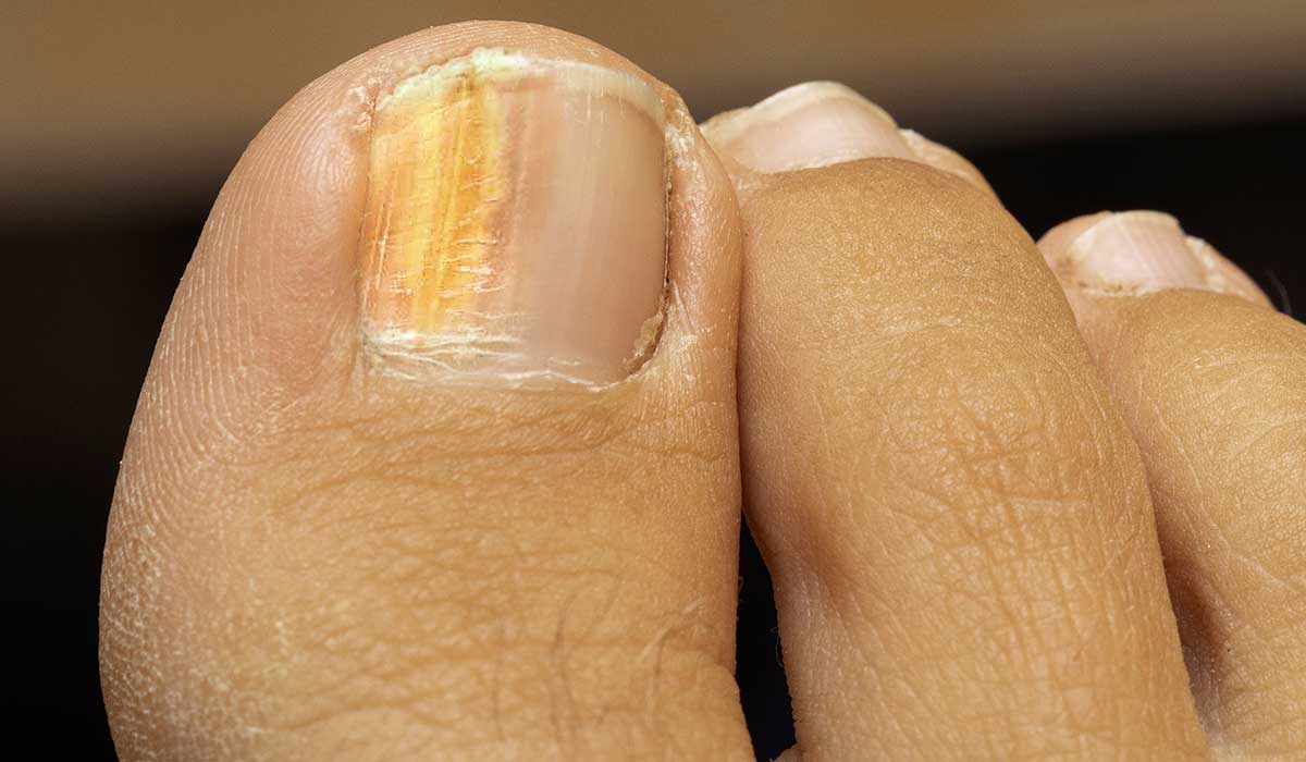 causas de las uñas amarillas en los pies