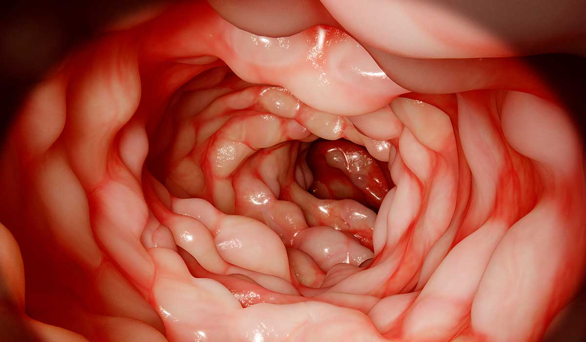 colitis ulcerosa y enfermedad de crohn en que se diferencian