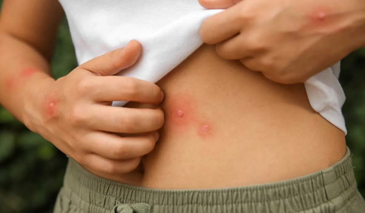 picaduras de insectos que necesitan atención médica inmediata
