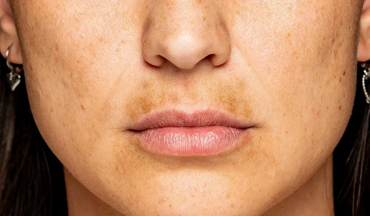 diferencias que existen entre las manchas que aparecen en la piel