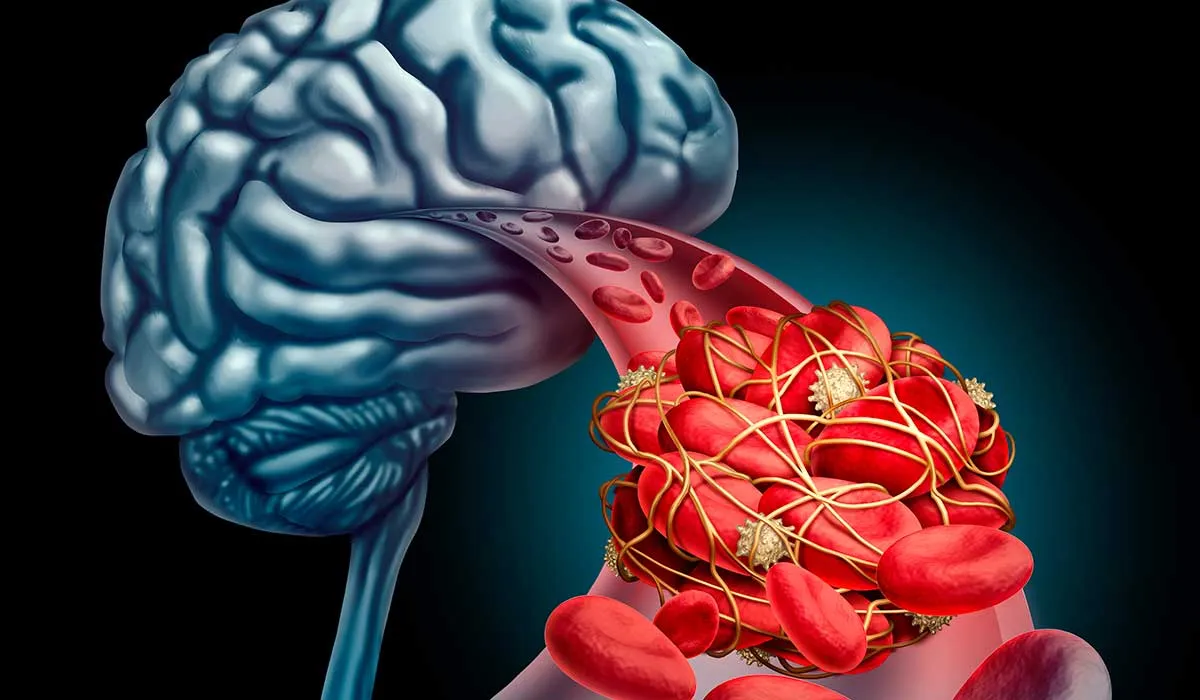 qué hacer si tú o alguien tiene un infarto cerebral