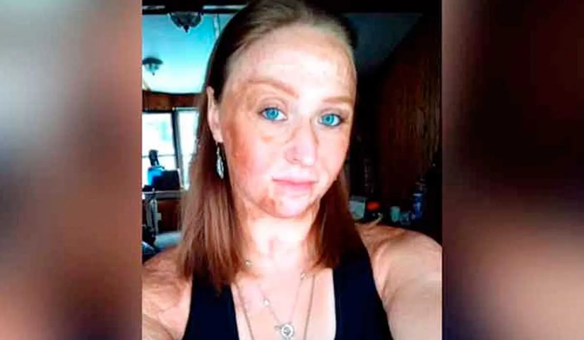 su mamá la prendió con gasolina para eliminar los piojos