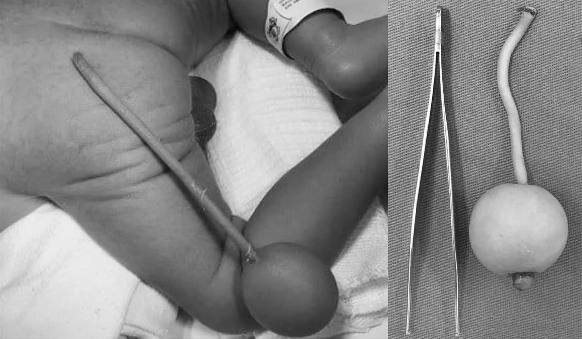 bebé nace con cola en Brasil