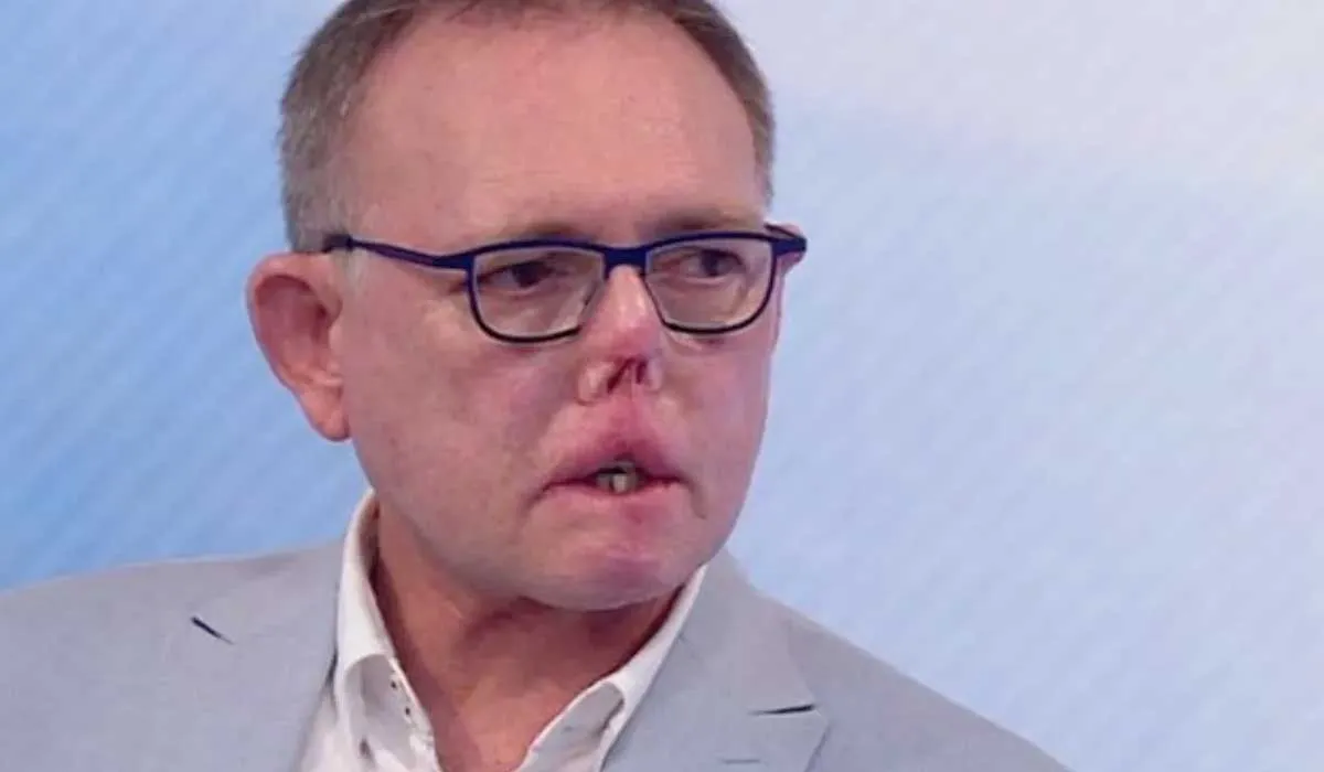 perdió sus dedos, piernas y parte de su nariz por culpa de su perro