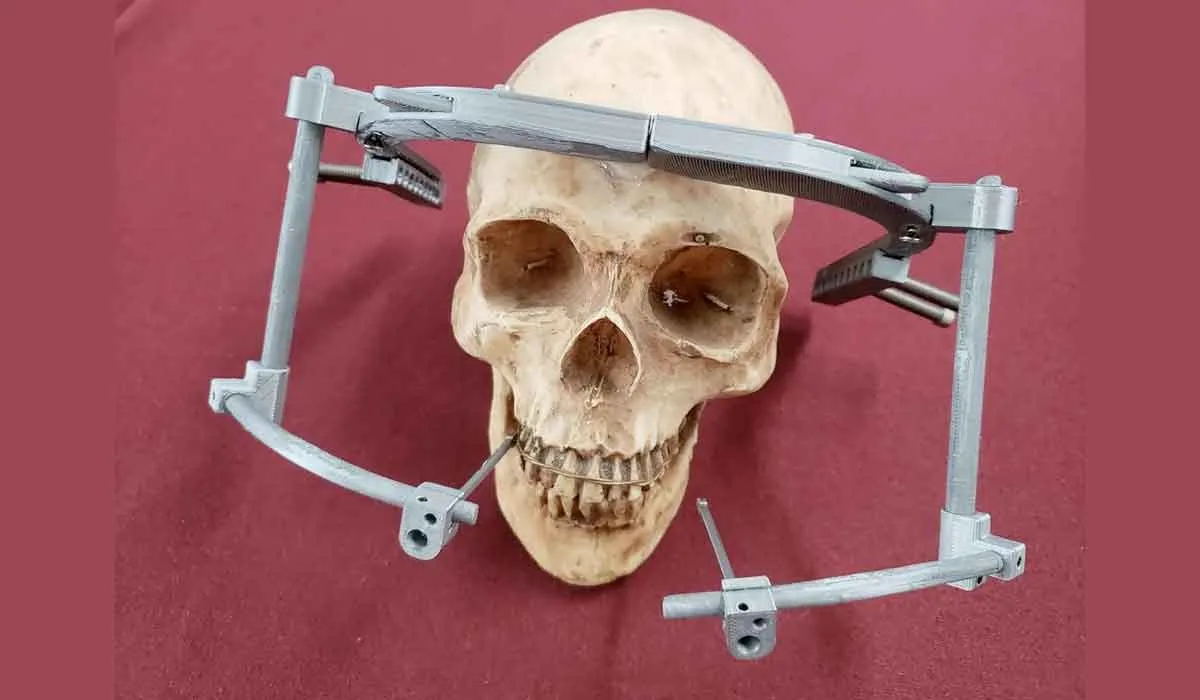 IPN crea dispositivo para corregir deformaciones craneales